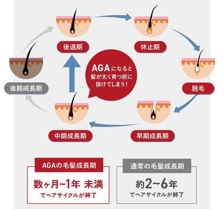 AGAの毛髪成長期 通常の毛髪成長期