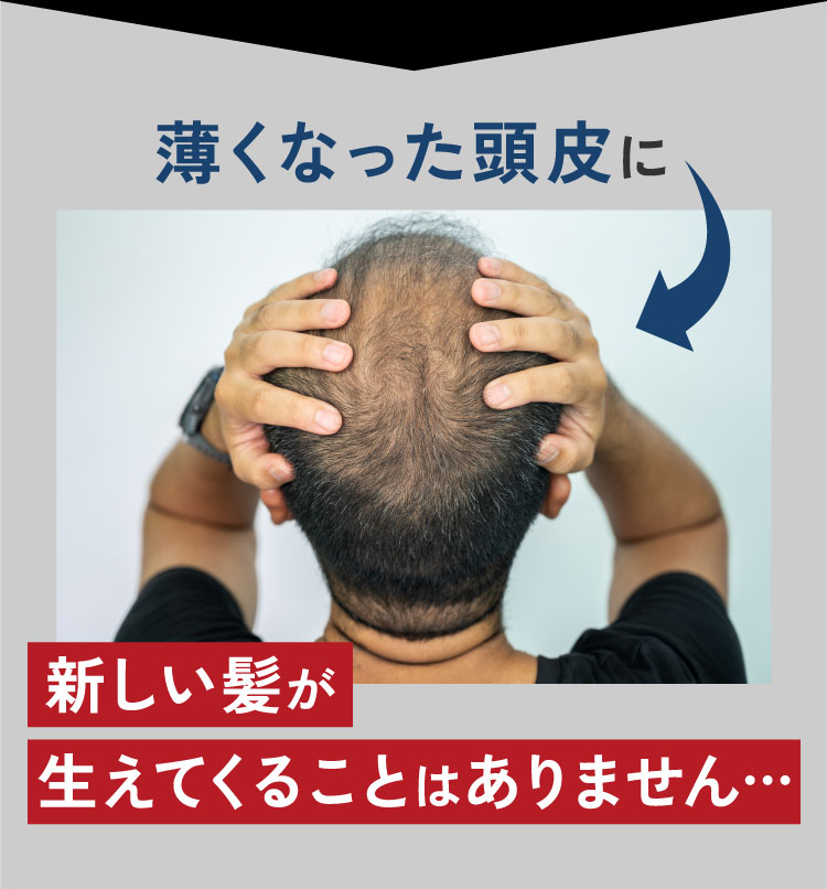 薄くなった頭皮に新しい髪が生えてくることはありません…