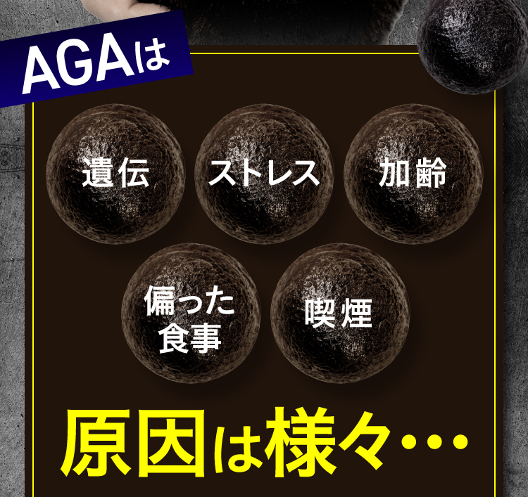 AGAの原因は様々…