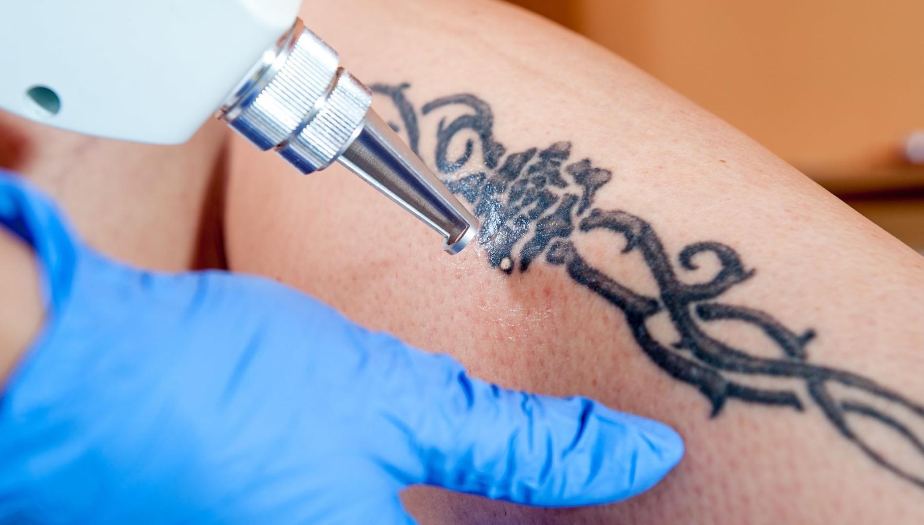 Close-up of a blue-gloved technician using a laser to remove a tattoo on a person's leg