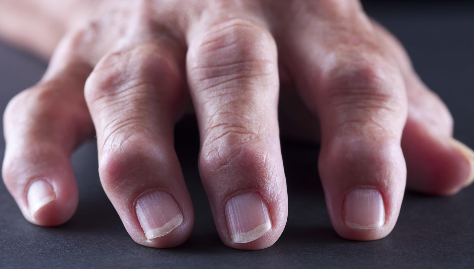 Close-up of a hand affected by arthritis