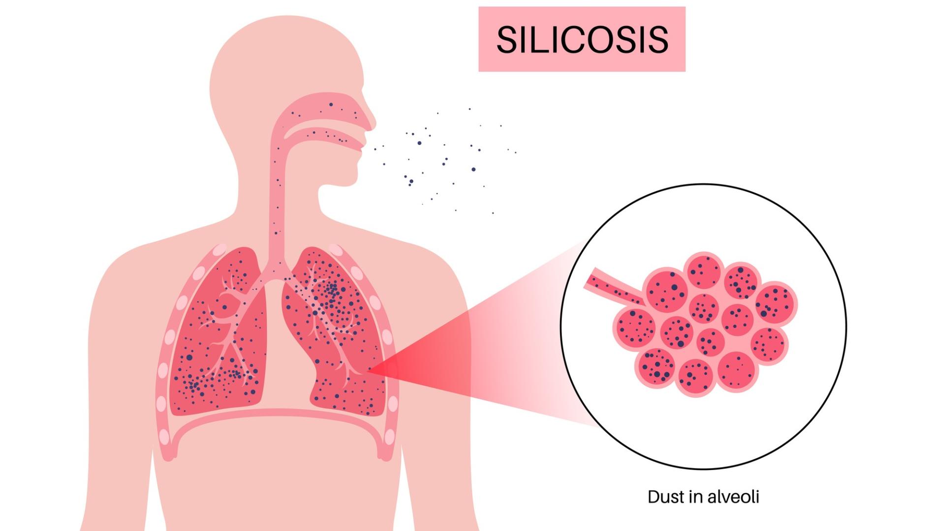 Silicosis anatomical poster