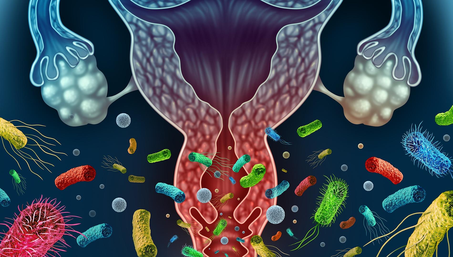 Bacterial Vaginosis concept as a vaginal inflammation caused by bacteria infection in the vagina with 3D illustration elements.