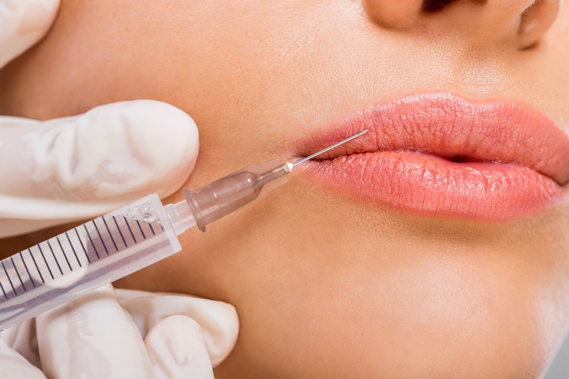 Close-up of a woman's lips about to injected with Botox 