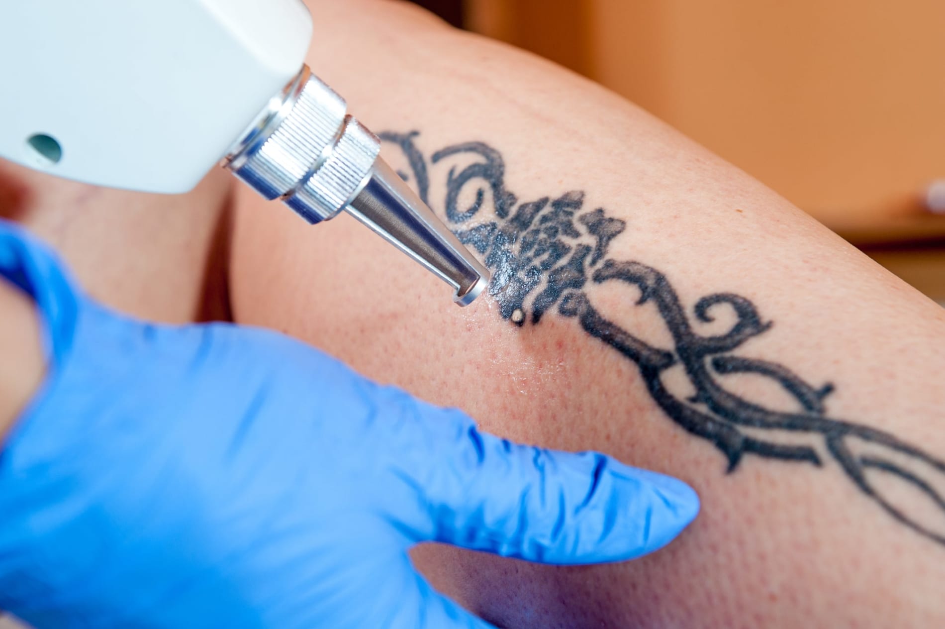 Close-up of a blue-gloved technician using a laser to remove a tattoo on a person's leg