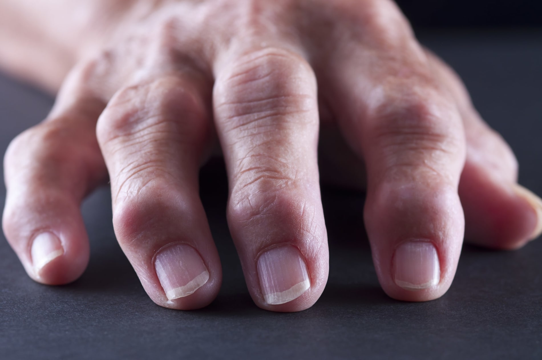 Close-up of a hand affected by arthritis