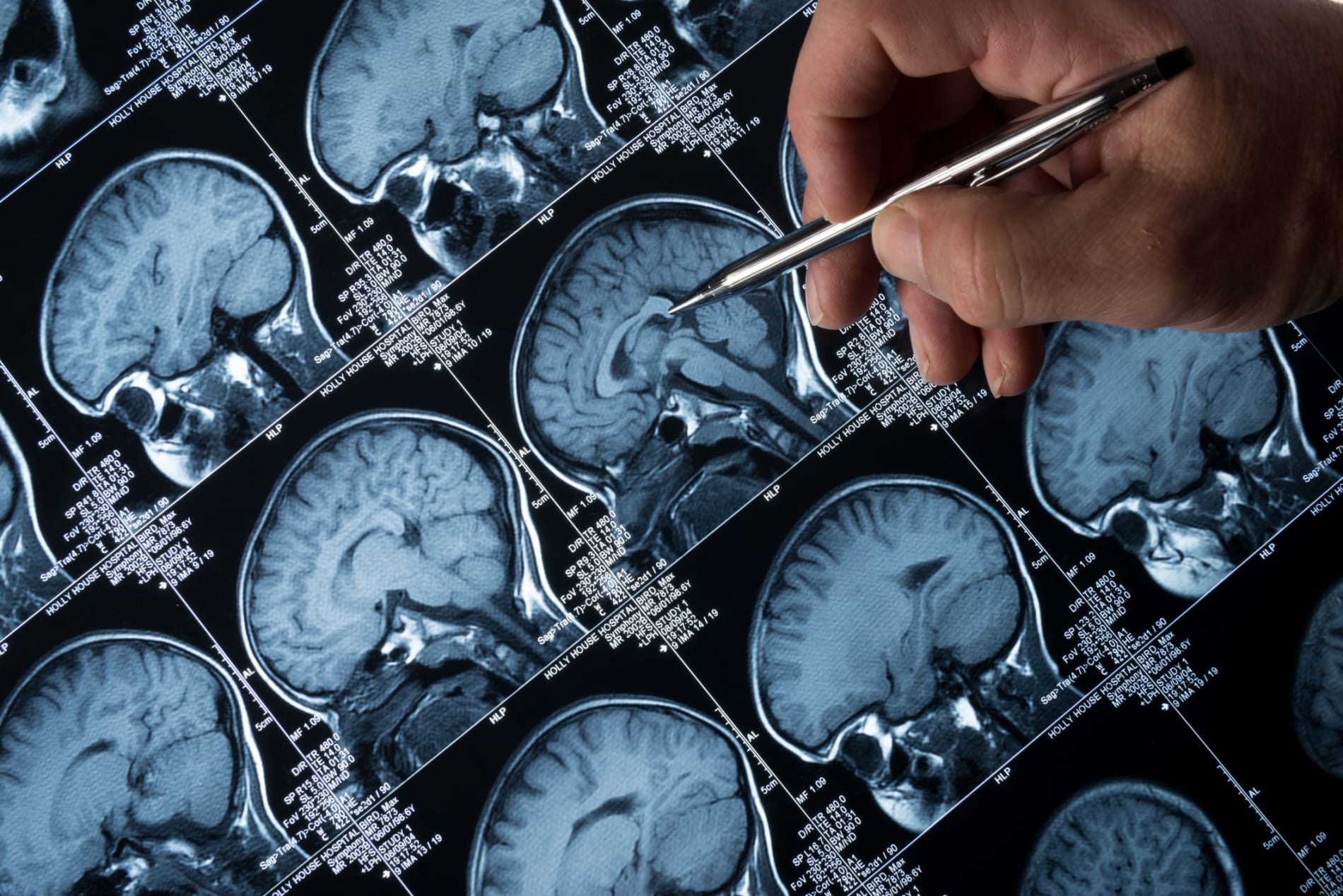 MRI Brain Scan of head and skull with hand, holding a pen, pointing