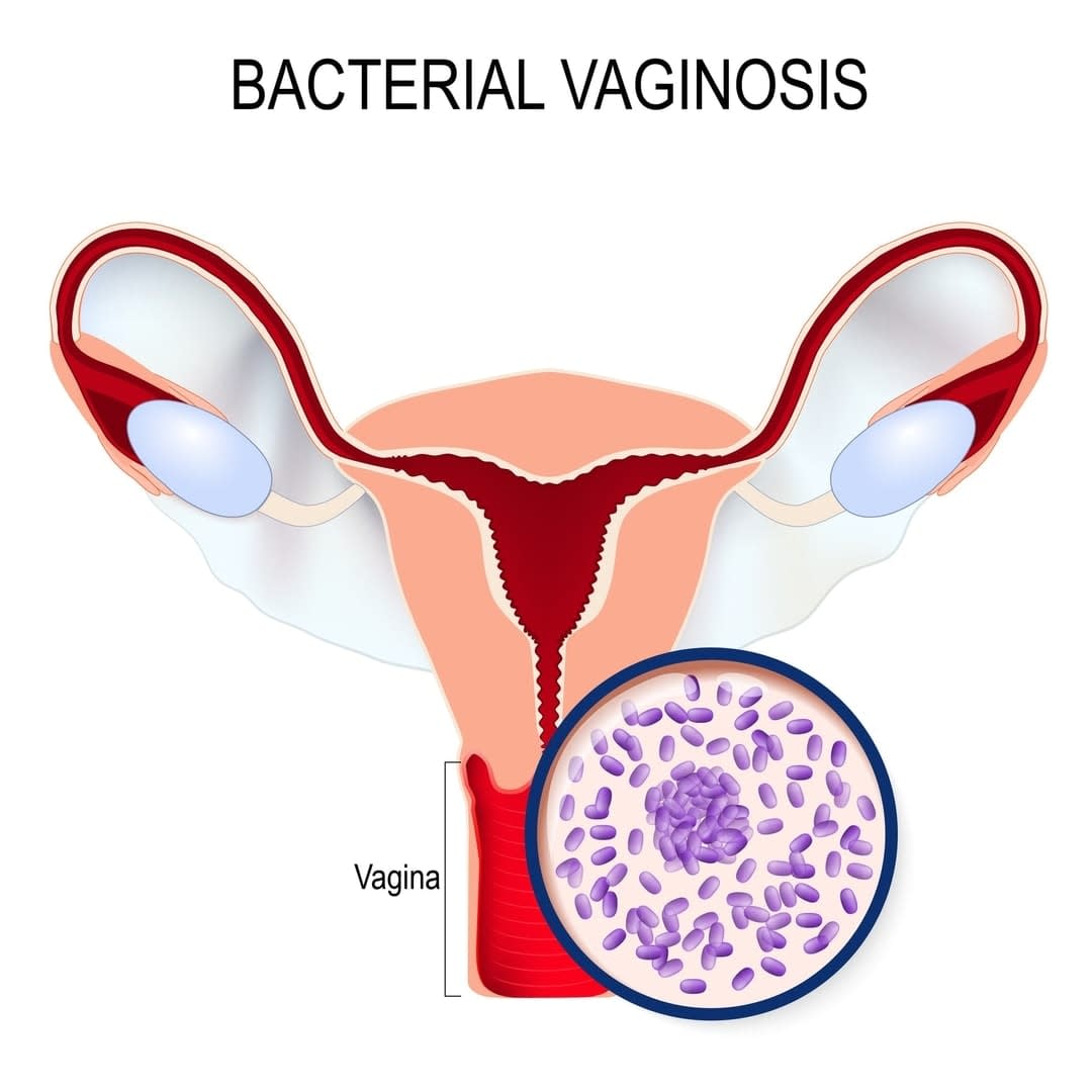 Bacterial vaginosis