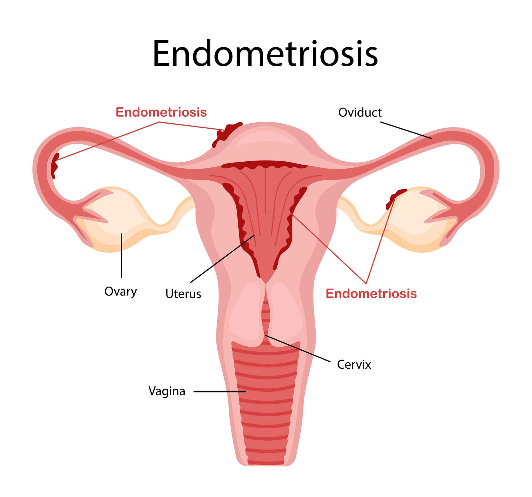 Ilustration diagram of the female reproductive system, depicting endometriosis disease