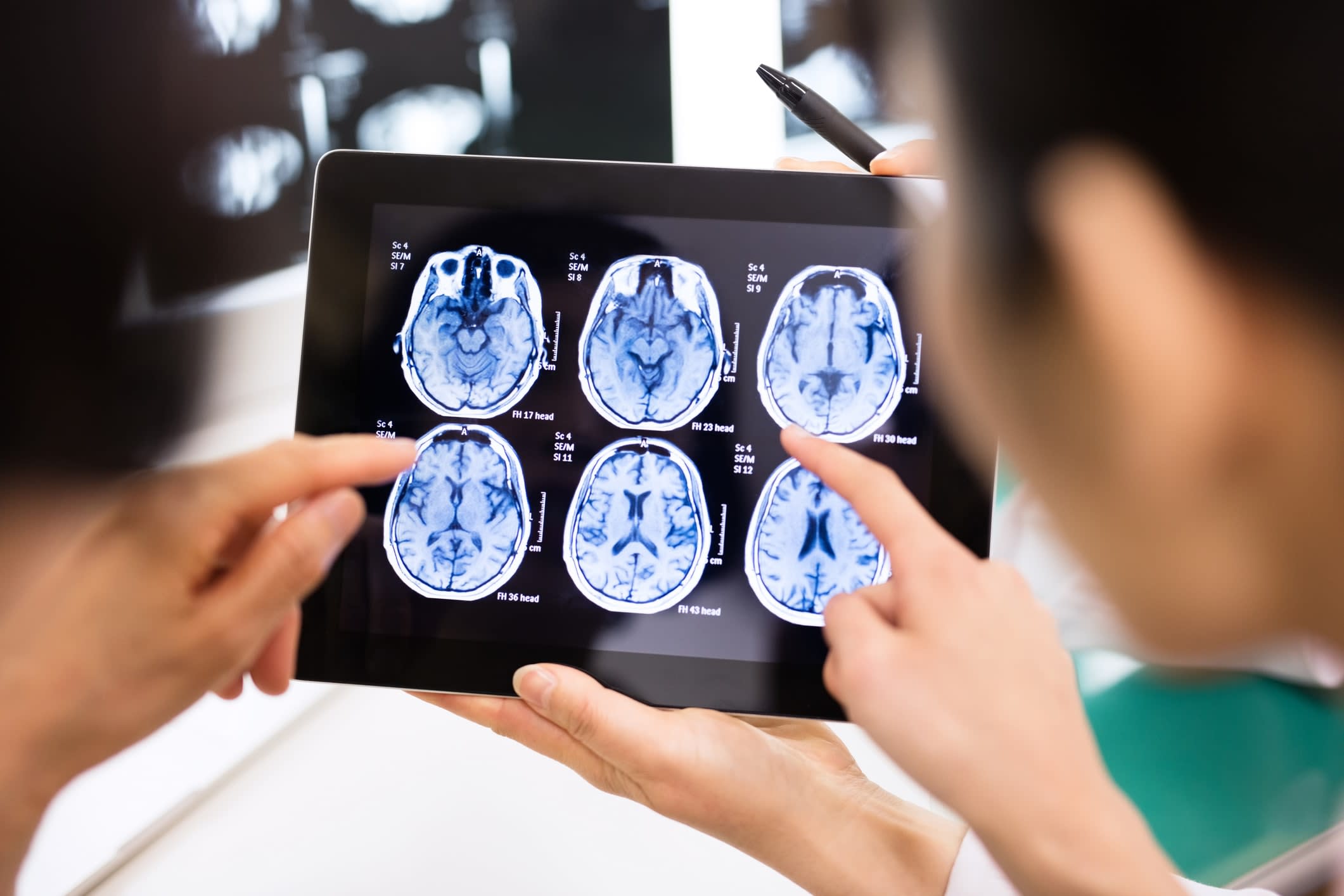 Medical staff examining brain scans on a digital tablet