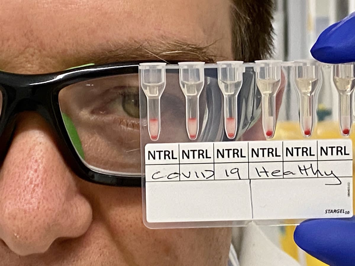 Close-up of Dr Simon Corrie's face as he holds up vials of a blood test 