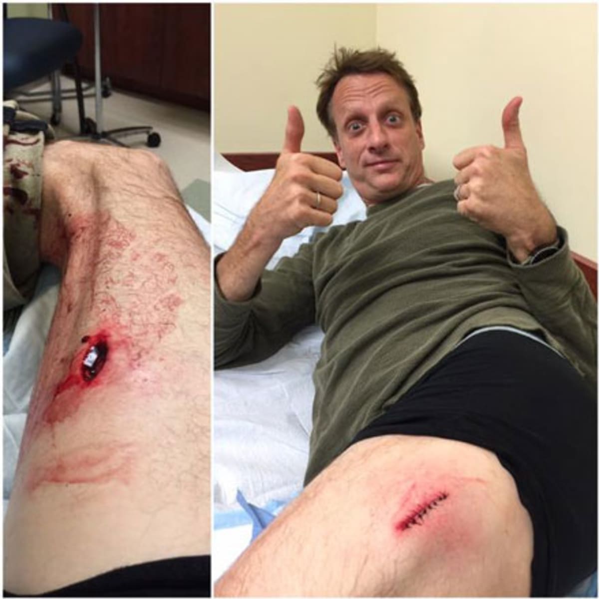 Tony hawk injuries