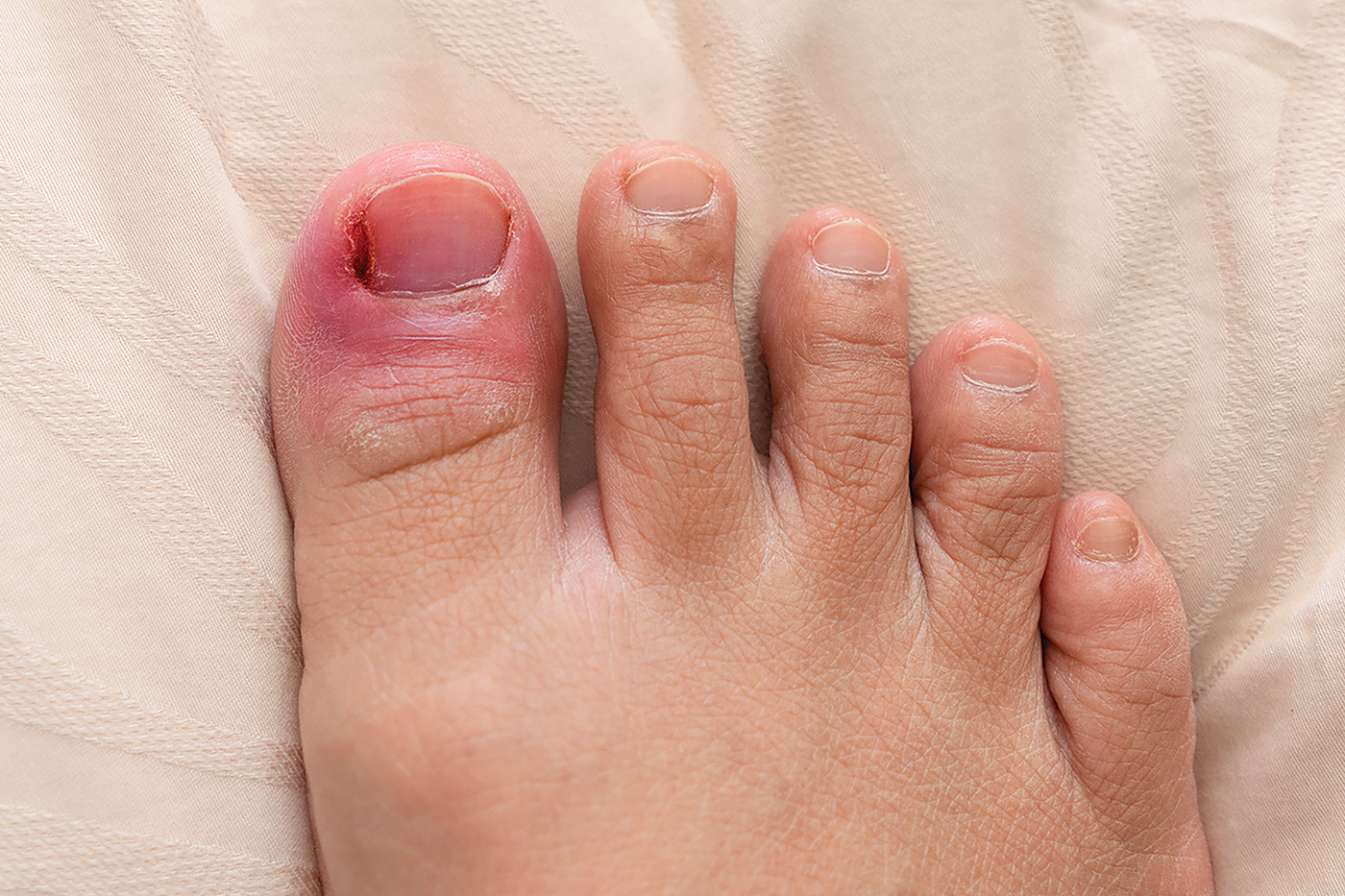 Ingrown nails, usually occor on the big toe