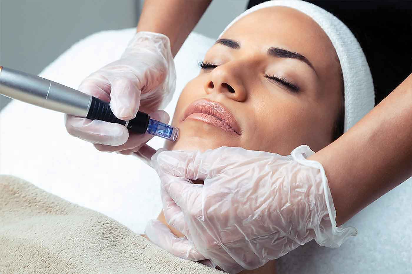 microneedling for treating acne scars