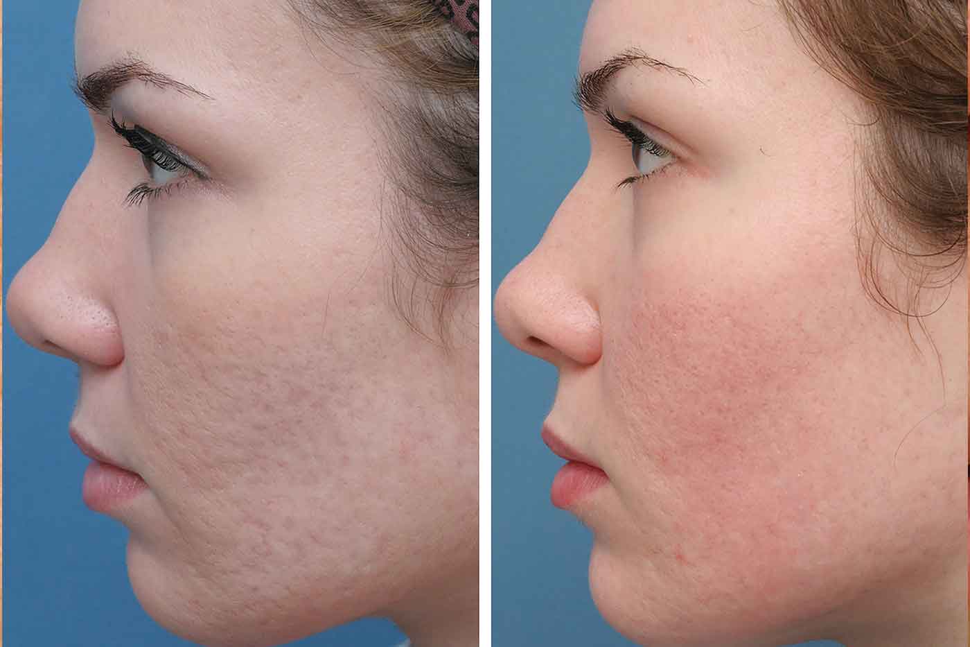 soft tissue fillers can help for the treatment of acne scars