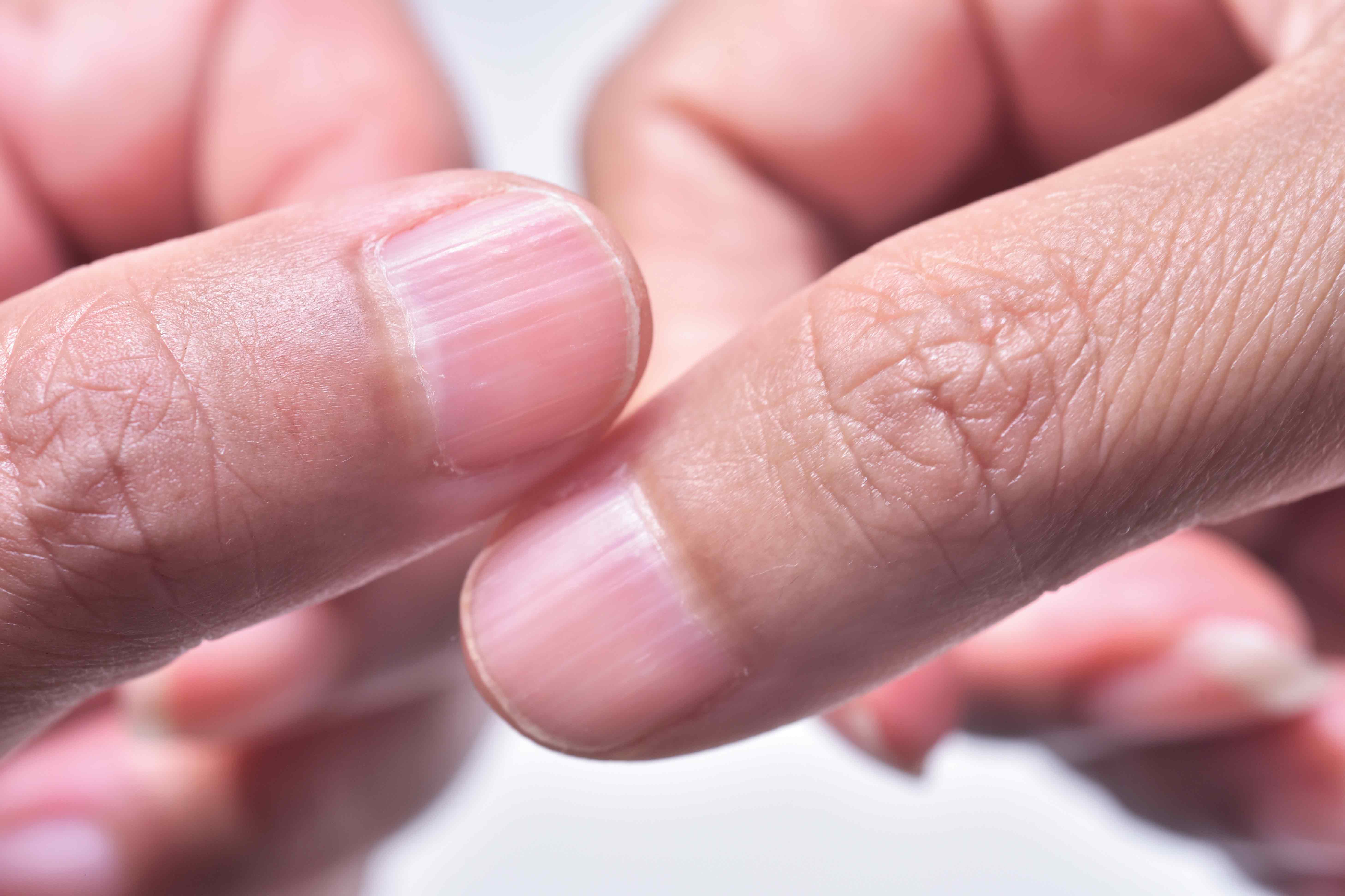 Psoriatic Arthritis Nails: Nail Problems and How to Manage Them