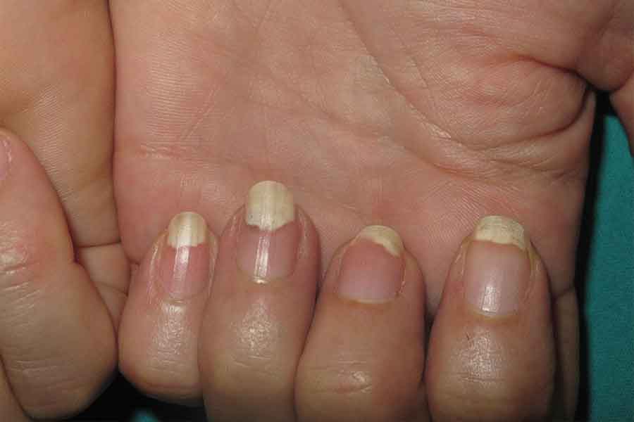 Thinning of natural nails