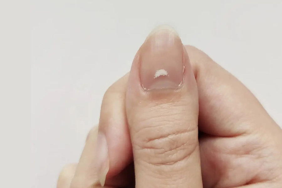 White Spots on Nails