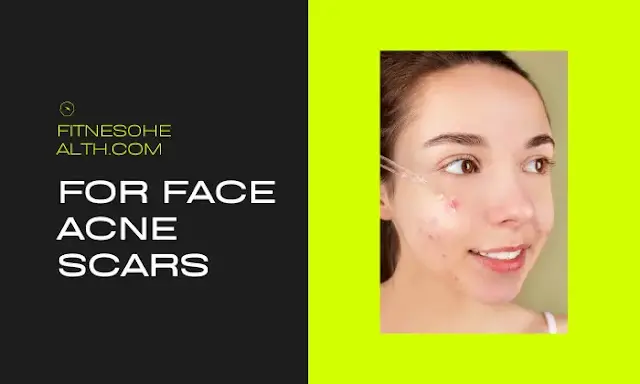 acne scars,scars,how to get rid of acne scars,acne scars treatment,how to fade acne scars,how to remove acne scars,fade acne scars,fade acne scars fast,how to treat acne scars,how to get rid of acne scars fast,acne scars solution,acne scars prevention,microneedling for acne scars,pitted acne scars,treating acne scars,how to fix acne scars,picosure acne scars,get rid of acne scars,fading acne scars on a budget,lasers for acne scars