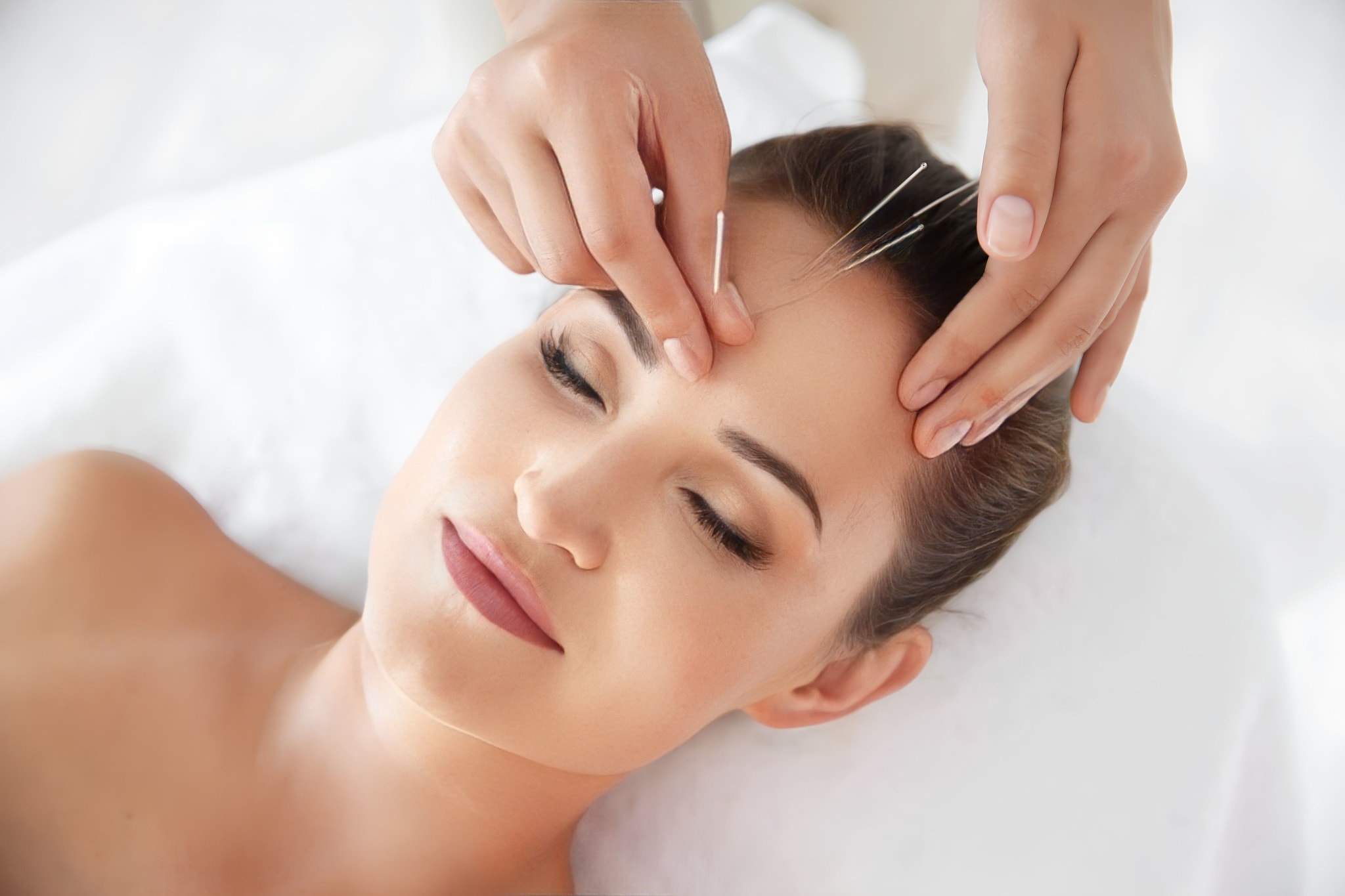 Acupuncture
