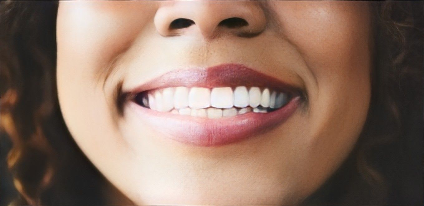 Restylane® Lip Lines Treatment