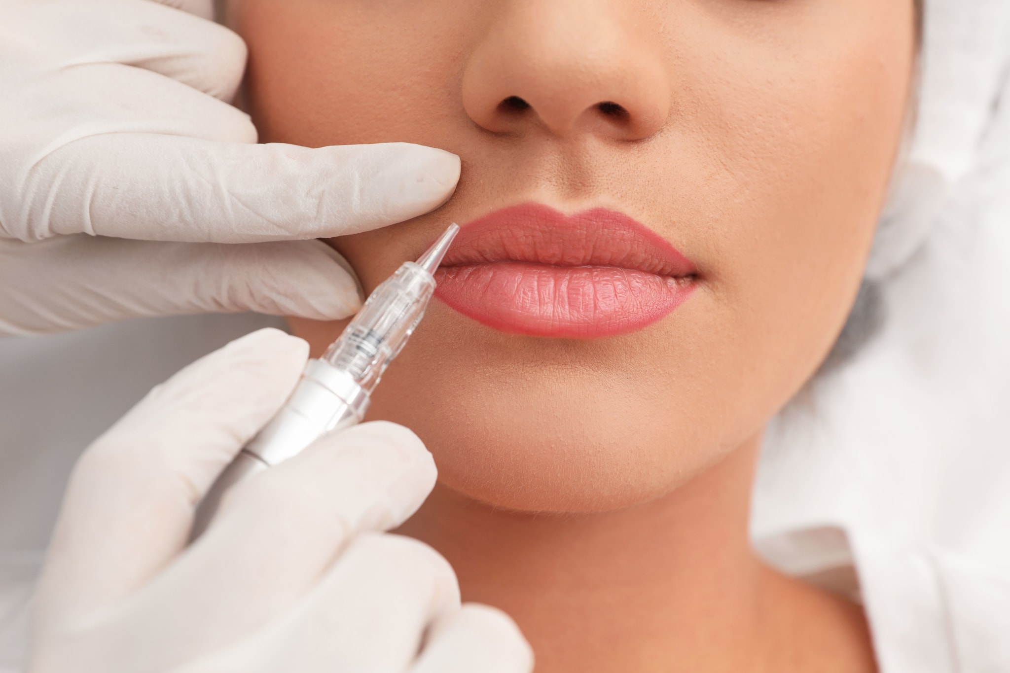Restylane Lip Enhancement and Lines Treatments