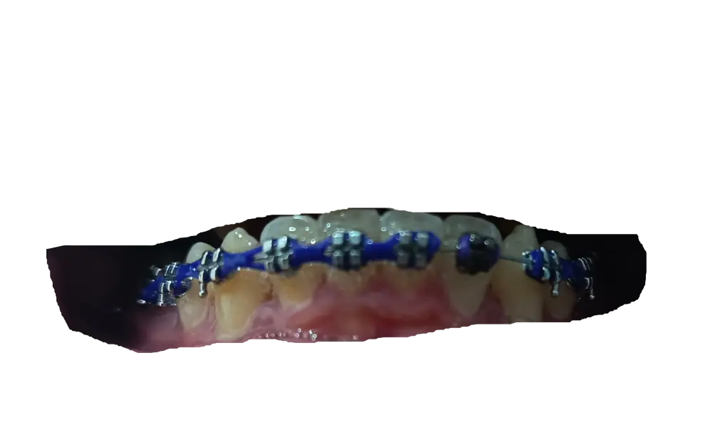 My lower teeth. Hmm...