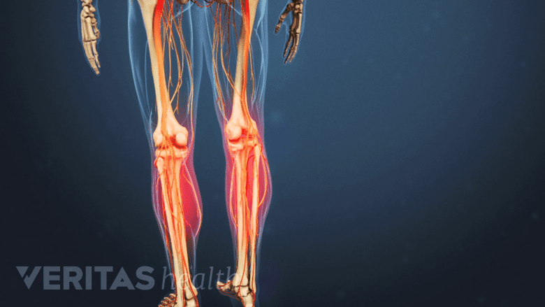 https://res.cloudinary.com/da1molee1/image/upload/c_fill%2Cg_center%2Ch_439%2Cw_780/q_auto%3Aeco/loss-motor-function-legs-cauda-equina-syndrome.png?_a=BAAAV6E0