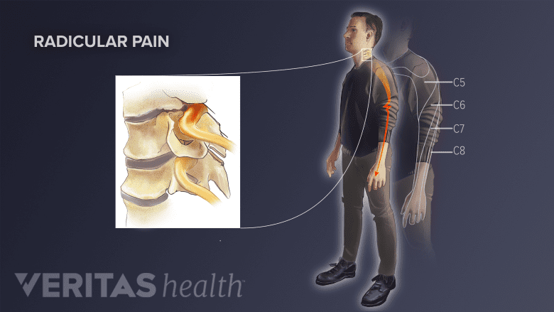Key signs of a pinched nerve