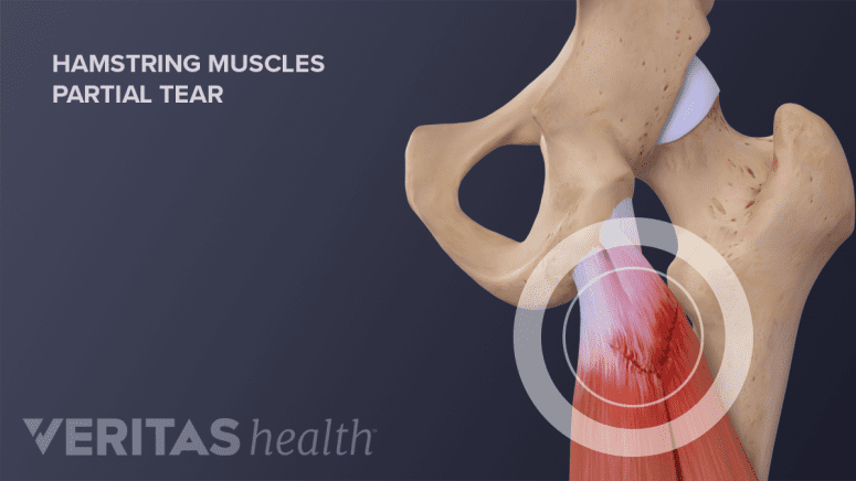 Detached Hamstring Injury Leg Injuries