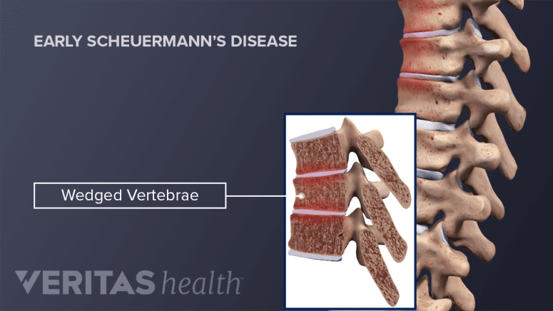 Scheuermanna Spinal Deformities