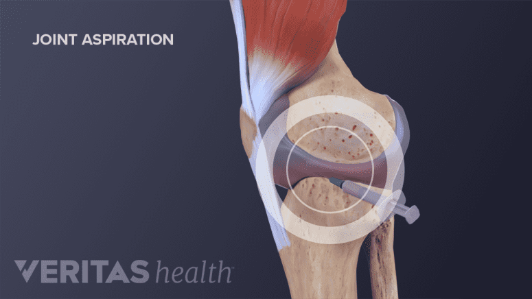 Joint Aspiration