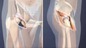 Minimally Invasive Hip Replacement vs. Traditional Hip Replacement