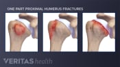 Examples of one part proximal humerus fractures