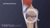Arthrocentisis in the knee joint.