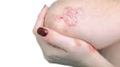 close up of elbow with psoriasis