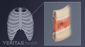 Medical illustration of intercostal muscle anatomy
