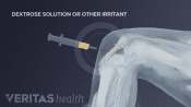 Prolotherapy injection in the knee