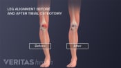 Medical illustartion showing the leg alignment before and after a tibial osteotomy surgery. After the surgery there is less bowness in the lower leg.