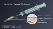 PRP injection being injected into a knee joint