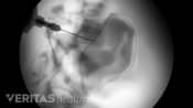 PRP injection through an x-ray.
