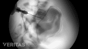 Xray view of an SI Joint Injection
