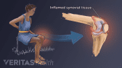 Reactive arthritis in the knee