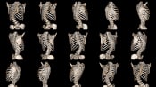 Assortment of scans detecting scoliosis in the spine.