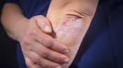 close up of elbow with psoriasis