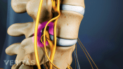 Profile view of cervical spine causing spinal cord compression.