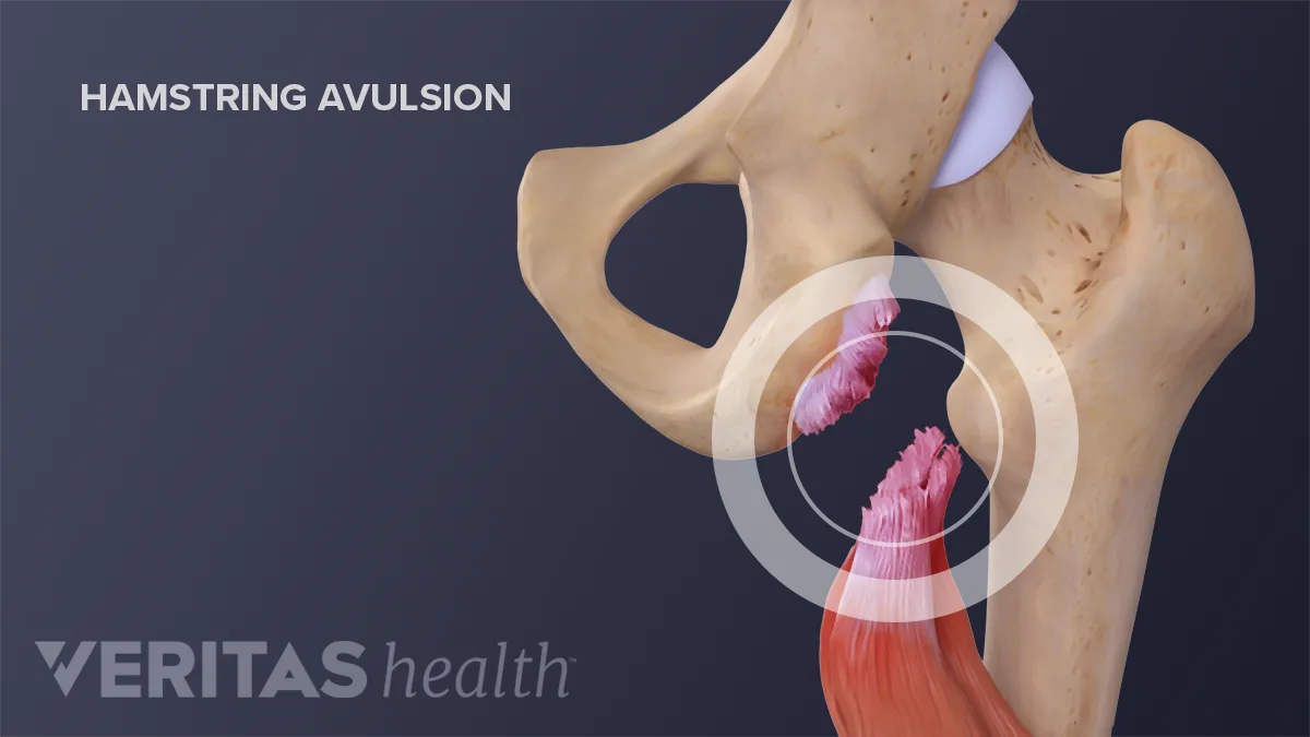 Hamstring Tears: Diagnosis | Sports-health