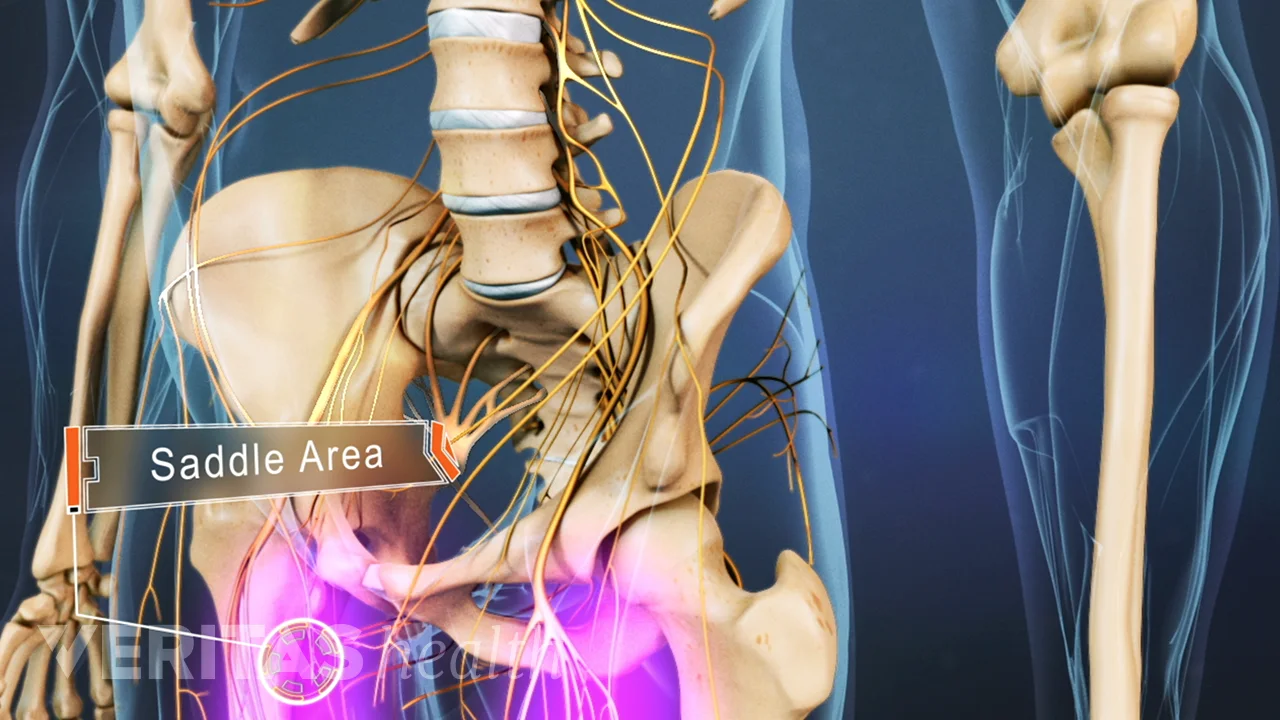 Causes of Cauda Equina Syndrome | Spine-health