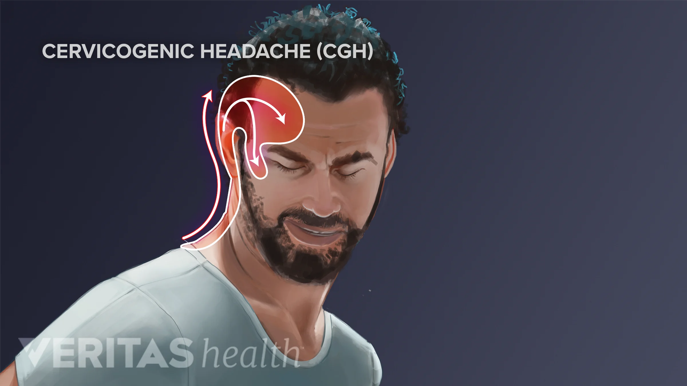 What Is Cervicogenic Headache Spine health