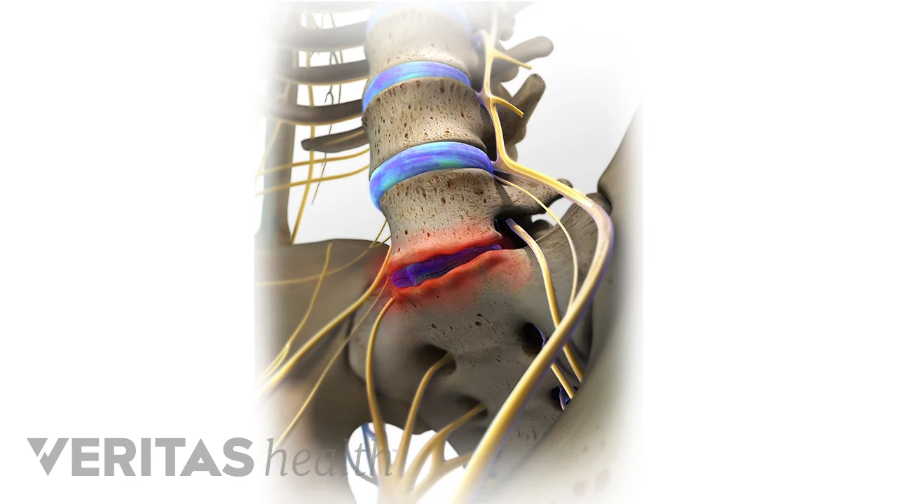 Degenerative Disc Disease Treatment Guidelines | Spine-health